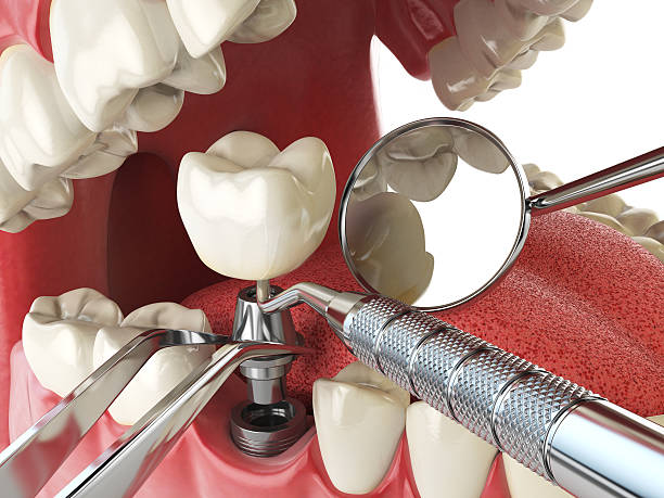 Best Emergency Dentist for Lost Fillings or Crowns in Highwood, IL